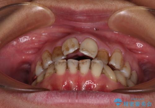 前歯の後戻り インビザラインでの再矯正治療の治療前