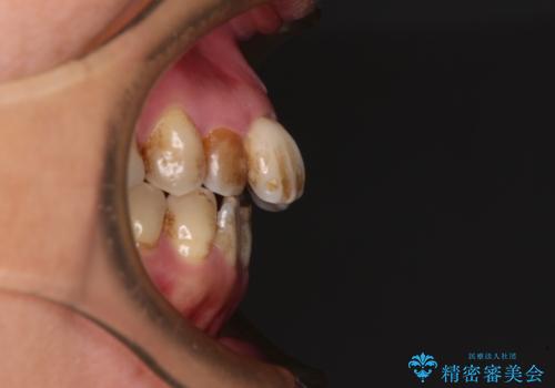 前歯の後戻り インビザラインでの再矯正治療の治療前