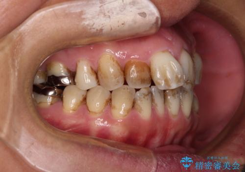 前歯の後戻り インビザラインでの再矯正治療の治療前