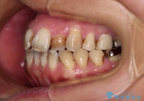 前歯の後戻り インビザラインでの再矯正治療の治療前