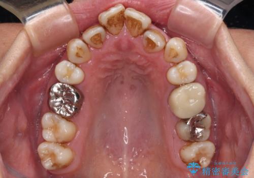 前歯の後戻り インビザラインでの再矯正治療の治療前