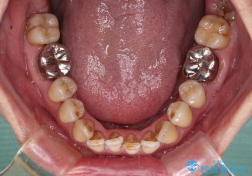 前歯の後戻り インビザラインでの再矯正治療の治療前