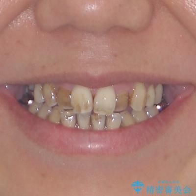 前歯の後戻り インビザラインでの再矯正治療の治療前(顔貌)