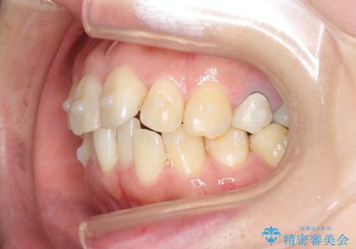 [ マウスピース矯正 ]  歯並びのずれが気になるの治療中