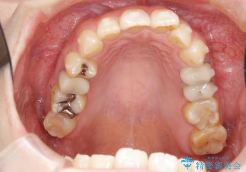 [ マウスピース矯正 ]  歯並びのずれが気になるの治療中
