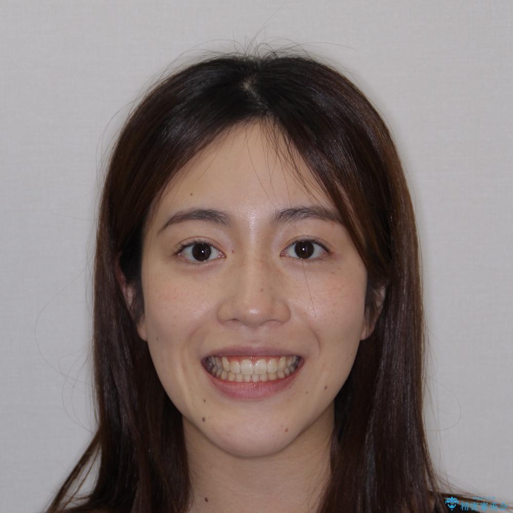 【モニター】上顎が狭い 急速拡大装置を用いたデコボコの解消の治療後(顔貌)