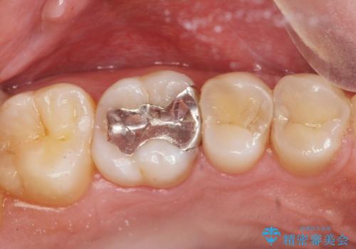 虫歯治療の症例 治療前