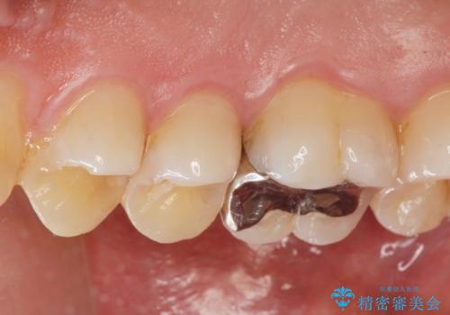 虫歯治療の治療前