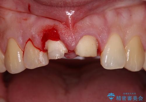 転んで欠けてしまった前歯 抜歯を回避してオールセラミッククラウンで審美回復の治療前