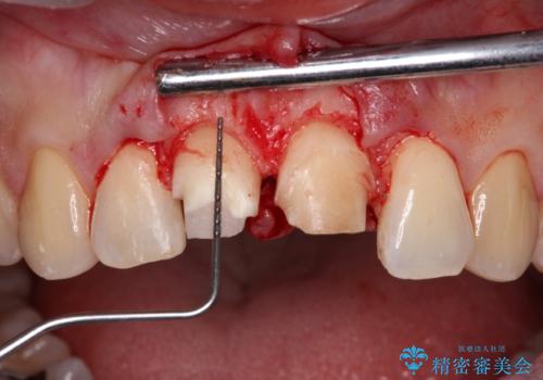 転んで欠けてしまった前歯 抜歯を回避してオールセラミッククラウンで審美回復の治療中