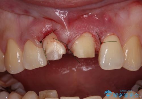 転んで欠けてしまった前歯 抜歯を回避してオールセラミッククラウンで審美回復の治療中