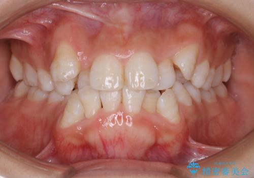 インビザライン単独での抜歯矯正治療