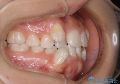 インビザライン単独での抜歯矯正治療の治療前