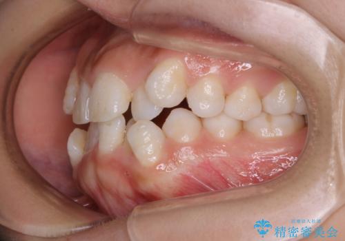 インビザライン単独での抜歯矯正治療の治療前