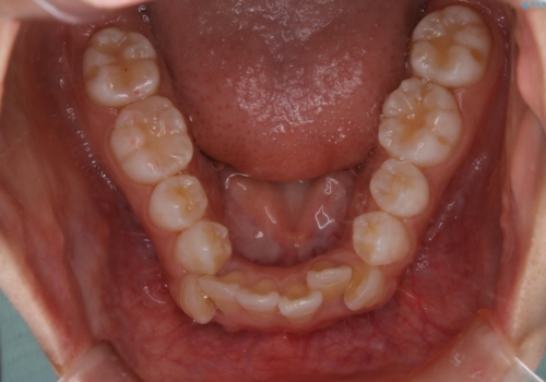 インビザライン単独での抜歯矯正治療の治療前