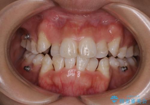 インビザライン単独での抜歯矯正治療の治療中