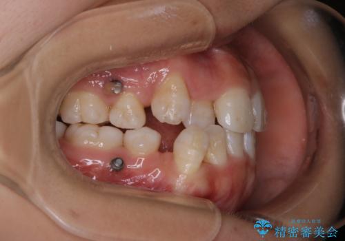 インビザライン単独での抜歯矯正治療の治療中