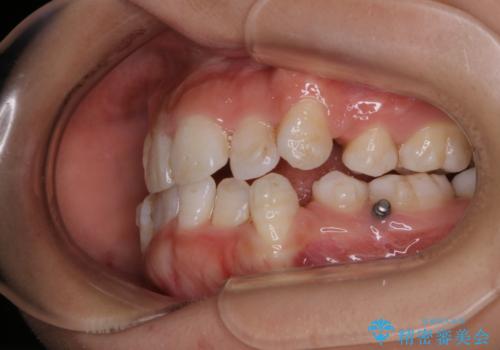 インビザライン単独での抜歯矯正治療の治療中