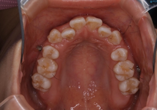 インビザライン単独での抜歯矯正治療の治療中
