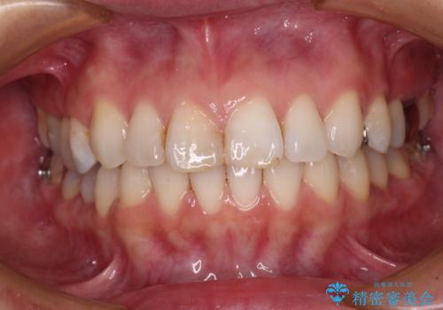 【モニター】前歯のデコボコを治したい インビザラインを用いた矯正治療の治療中