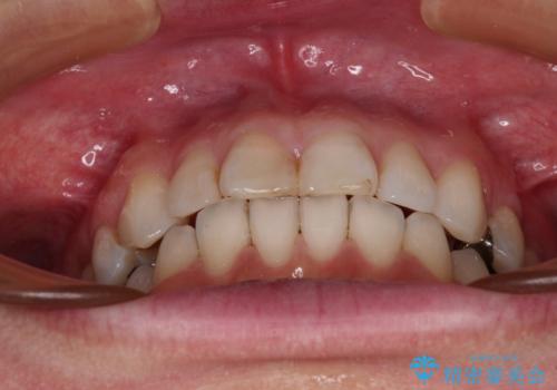 【モニター】前歯のデコボコを治したい インビザラインを用いた矯正治療の治療中