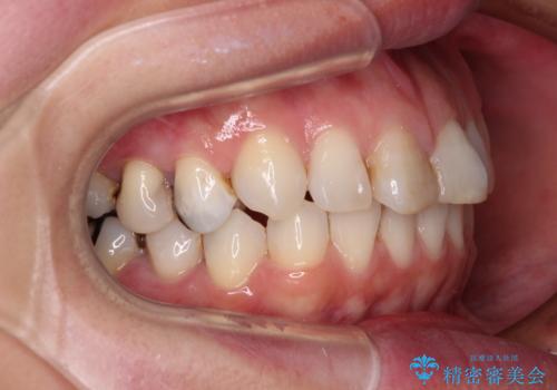 【モニター】前歯のデコボコを治したい インビザラインを用いた矯正治療の治療中