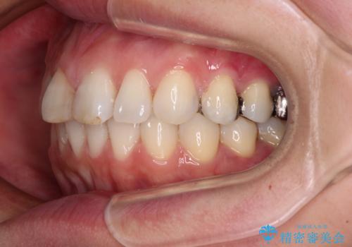 【モニター】前歯のデコボコを治したい インビザラインを用いた矯正治療の治療中