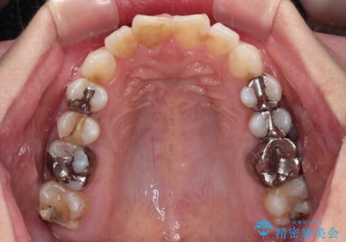 【モニター】前歯のデコボコを治したい インビザラインを用いた矯正治療の治療中