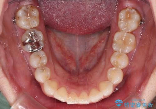 【モニター】前歯のデコボコを治したい インビザラインを用いた矯正治療の治療中