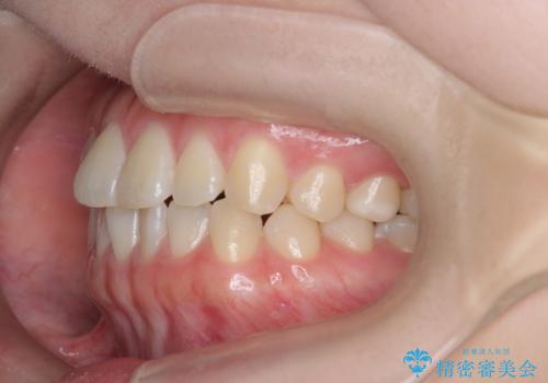 [ インビザラインライト ]   14枚で行う前歯のみの短期間マウスピース矯正の治療前