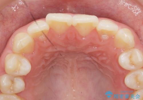 [ インビザラインライト ]   14枚で行う前歯のみの短期間マウスピース矯正の症例 治療前