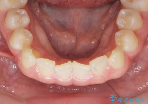 [ インビザラインライト ]   14枚で行う前歯のみの短期間マウスピース矯正の治療前