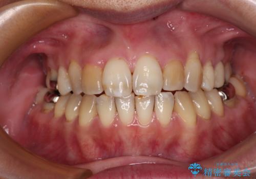 前歯の後戻り インビザラインでの再矯正治療の治療中
