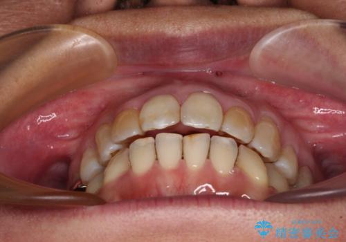 前歯の後戻り インビザラインでの再矯正治療の治療中