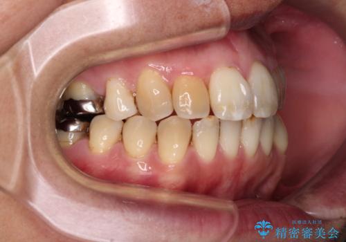 前歯の後戻り インビザラインでの再矯正治療の治療中