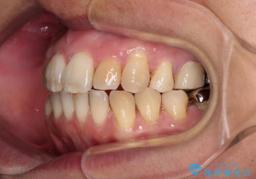 前歯の後戻り インビザラインでの再矯正治療の治療中