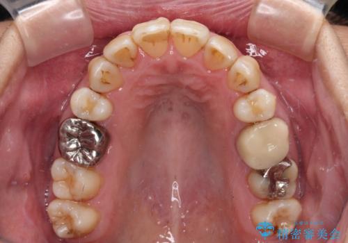前歯の後戻り インビザラインでの再矯正治療の治療中
