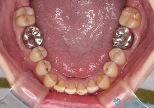 前歯の後戻り インビザラインでの再矯正治療の治療中