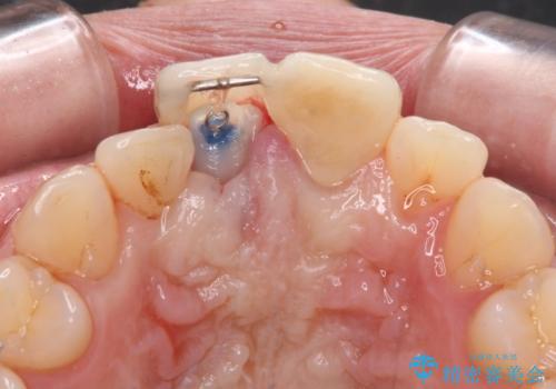 転んで欠けてしまった前歯 抜歯を回避してオールセラミッククラウンで審美回復の治療中