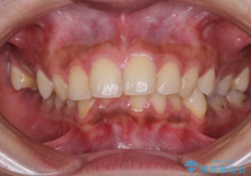 深い咬み合わせと前歯のデコボコ　インビザラインによる矯正治療の症例 治療前