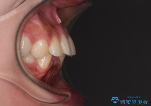 深い咬み合わせと前歯のデコボコ インビザラインによる矯正治療の治療前
