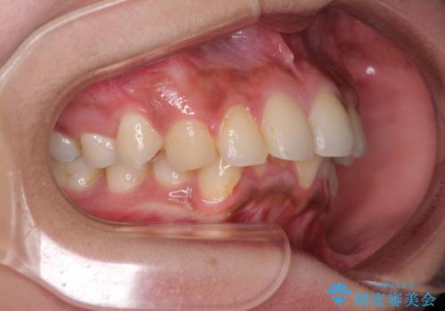 深い咬み合わせと前歯のデコボコ インビザラインによる矯正治療の治療前