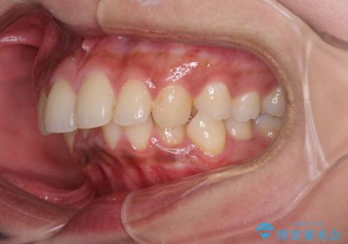 深い咬み合わせと前歯のデコボコ インビザラインによる矯正治療の治療前