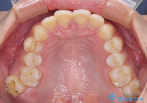 深い咬み合わせと前歯のデコボコ　インビザラインによる矯正治療の治療前