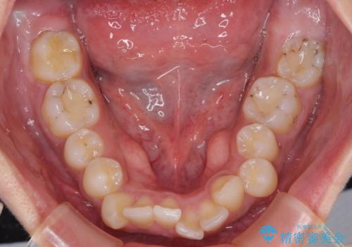 深い咬み合わせと前歯のデコボコ インビザラインによる矯正治療の治療前