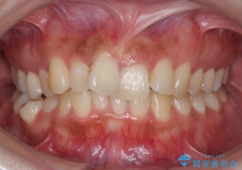 マウスピース矯正では難しい治療にも対応します　歯を抜かない矯正の治療前