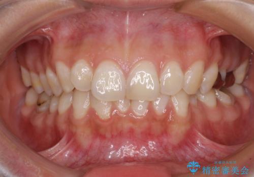 【モニター】隠れている下顎の前歯をインビザラインで改善の症例 治療前