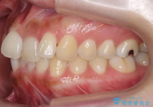 マウスピース矯正では難しい治療にも対応します 歯を抜かない矯正の治療前