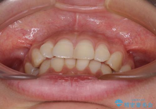 【モニター】隠れている下顎の前歯をインビザラインで改善の治療前