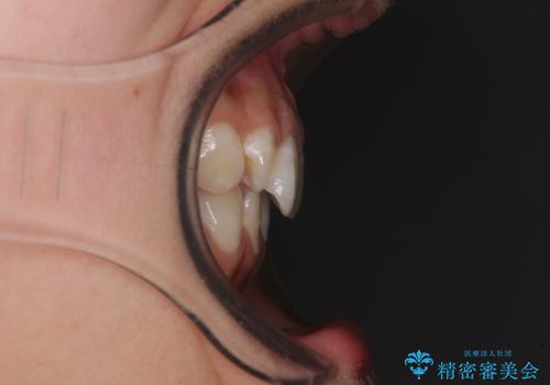 【モニター】隠れている下顎の前歯をインビザラインで改善の治療前